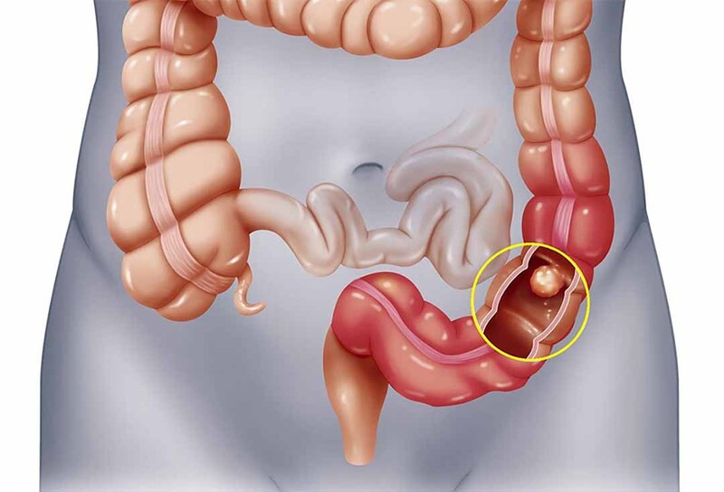 Táo bón thực thể có thể do tổn thương hậu môn hoặc trực tràng