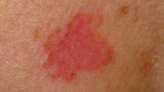 Ung thư biểu mô tế bào đáy (Basal Cell Carcinoma)
