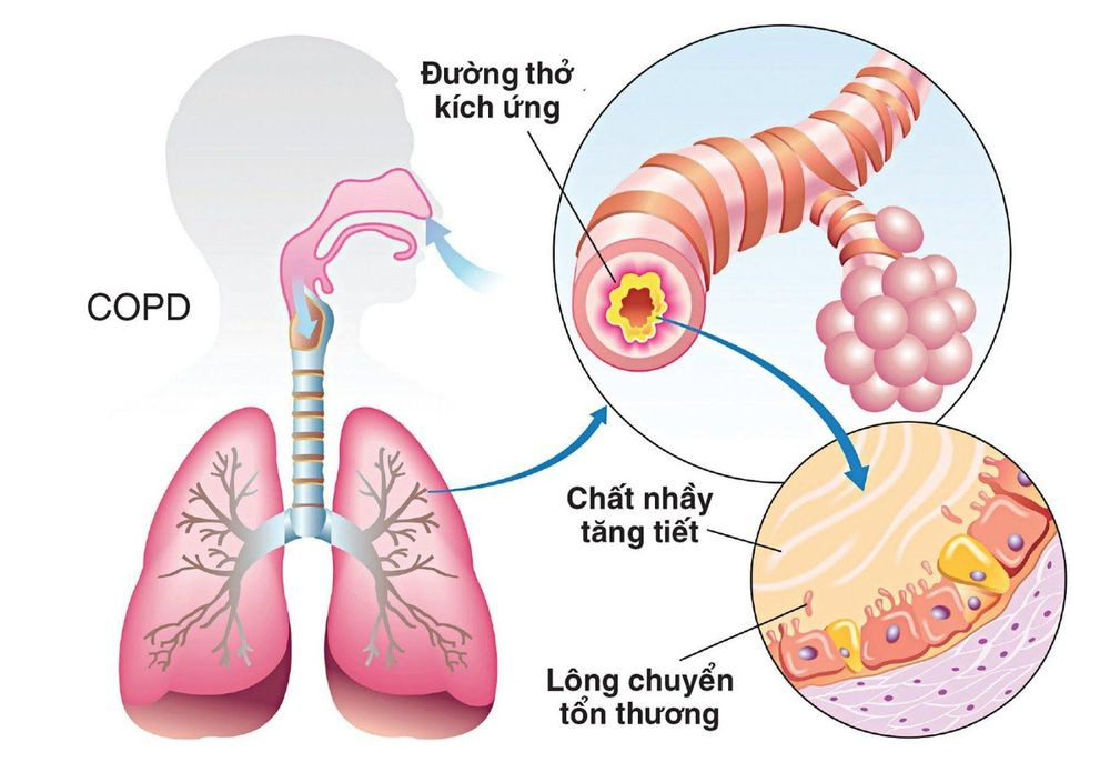 Cơ chế hình thành bệnh phổi tắc nghẽn mãn tính