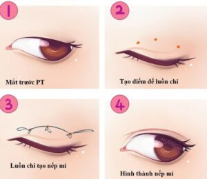 Bấm mí là kỹ thuật nhanh chóng và ít xâm lấn, giúp tạo hình mí mắt rõ ràng hơn