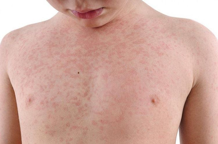 Ban Rubella xuất hiện đầu tiên ở đầu và mặt, sau đó lan ra toàn thân