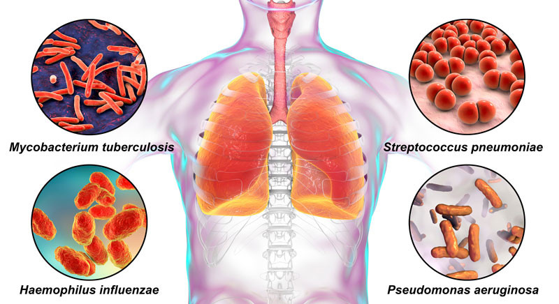 Các bệnh do phế cầu khuẩn gây ra