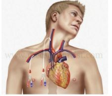 Catheter tĩnh mạch trung tâm