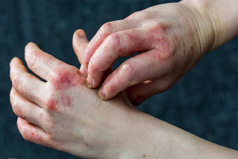 Các triệu chứng thường gặp của bệnh eczema