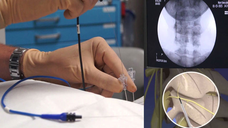 RFA là phương pháp sử dụng năng lượng sóng vô tuyến để tạo ra nhiệt phá hủy các mô đích trong cơ thể, bao gồm tế bào ung thư và các khối u, giúp điều trị bệnh hiệu quả.