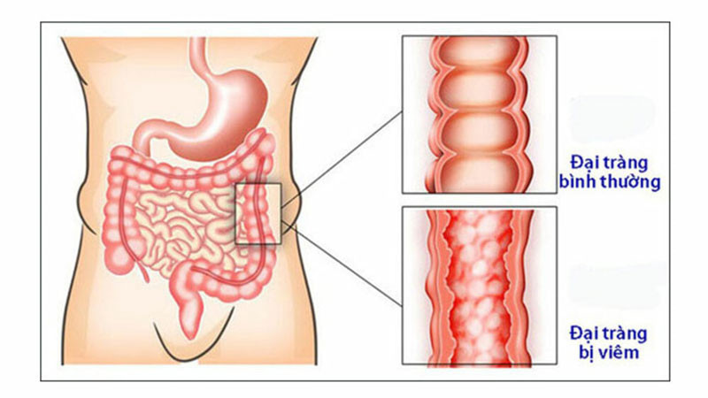 Hình ảnh minh họa viêm loét đại tràng