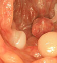 Polyp hình thành như thế nào?