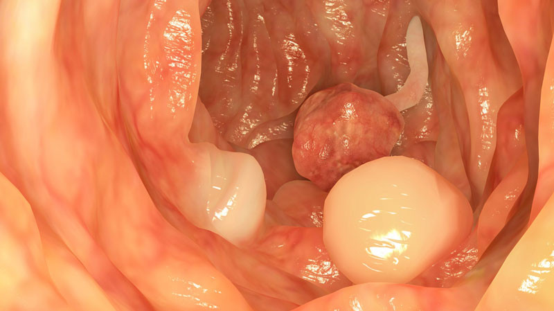 Polyp hình thành như thế nào?
