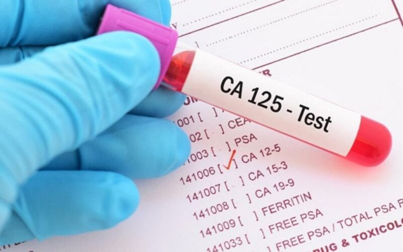 Xét nghiệm CA125 giúp phát hiện ung thư buồng trứng