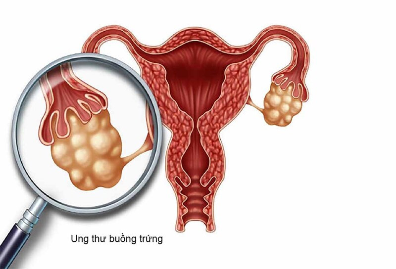 Xét nghiệm CA 125 cho người nghi ngờ bị ung thư buồng trứng
