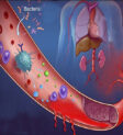 So sánh nhiễm trùng huyết và sepsis