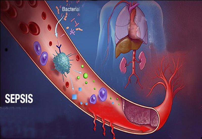 So sánh nhiễm trùng huyết và sepsis