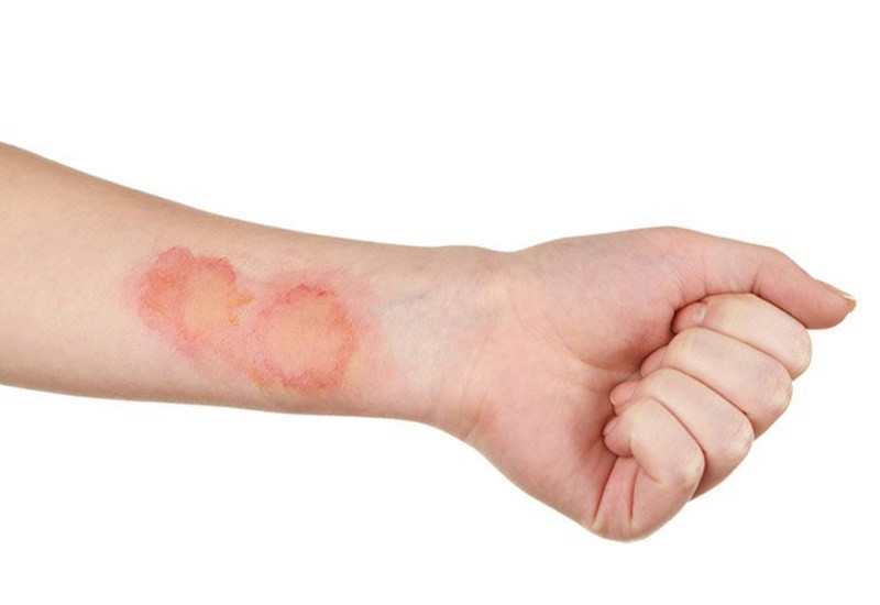 Nhiễm trùng da có thể gây ra nhiễm trùng huyết