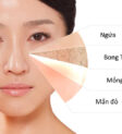 Da nhạy cảm là gì? Một làn da dễ bị kích ứng và mẩn đỏ