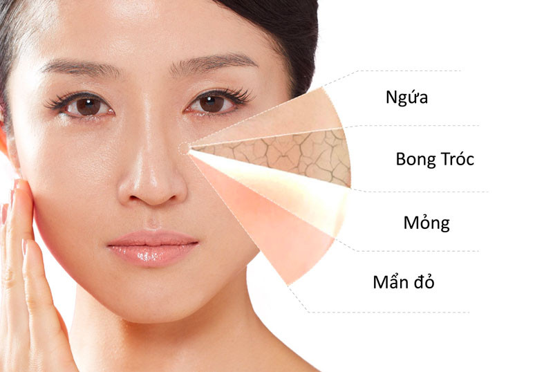 Da nhạy cảm là gì? Một làn da dễ bị kích ứng và mẩn đỏ