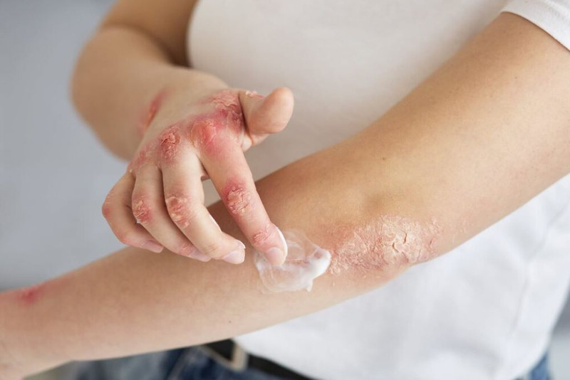 Tiêu Cayenne: Hỗ trợ điều trị bệnh vẩy nến