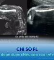 Đo chiều dài xương đùi trong siêu âm thai nhi, chỉ số FL dự đoán chiều cao của trẻ