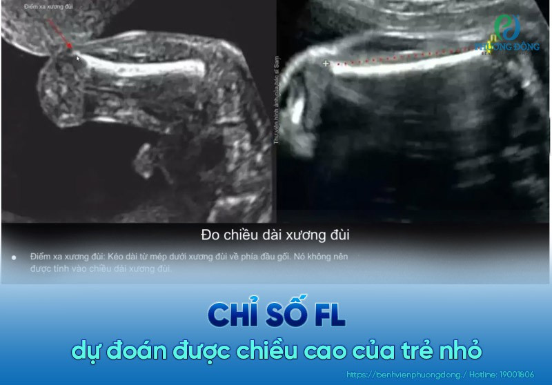 Đo chiều dài xương đùi trong siêu âm thai nhi, chỉ số FL dự đoán chiều cao của trẻ