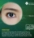 Củng mạc (Sclera) tại Bệnh viện Mắt Sài Gòn giúp bảo vệ đôi mắt của bạn
