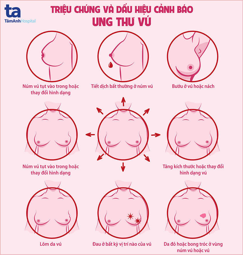 dấu hiệu ung thư vú