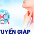 fna tuyến giáp