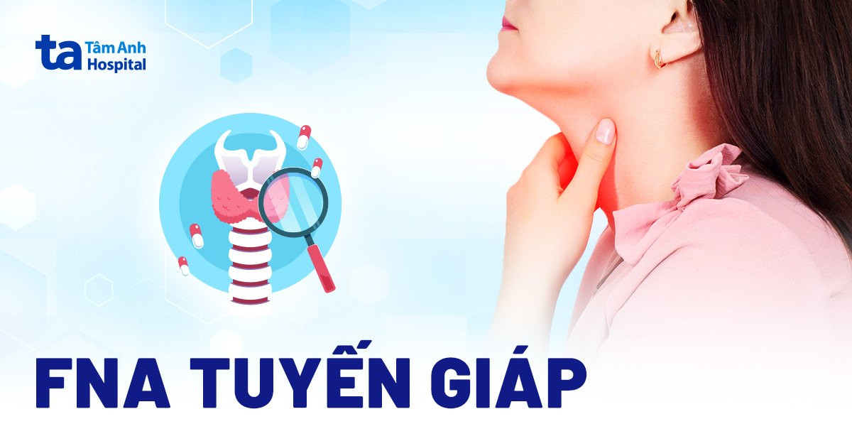 fna tuyến giáp