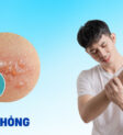 Hình ảnh ghẻ phỏng với các mụn nước và vảy vàng mật ong