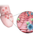 nguyên nhân gây herpes sinh dục