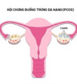 Hội chứng buồng trứng đa nang
