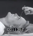 Phẫu thuật Lobotomy Là Gì? Khám Phá Sự Thật Về Phương Pháp Rợn Người Này