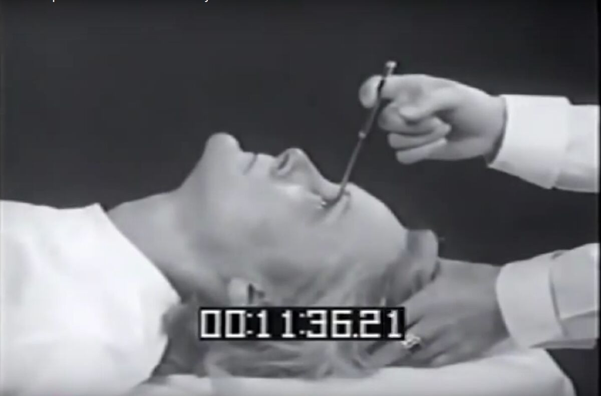 Phẫu thuật Lobotomy Là Gì? Khám Phá Sự Thật Về Phương Pháp Rợn Người Này