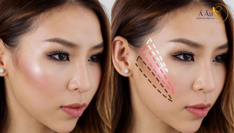 Thẩm mỹ nâng gò má giúp cải thiện vẻ ngoài tươi tắn và trẻ trung