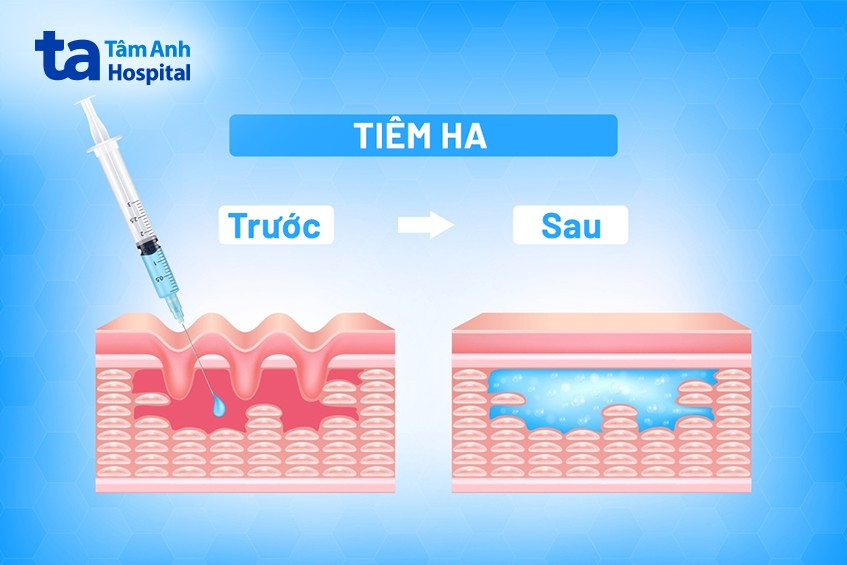 Lưu ý trước và sau khi tiêm HA
