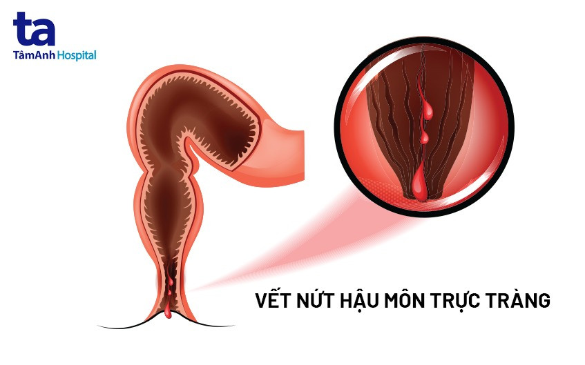 Nguyên nhân gây nứt kẽ hậu môn