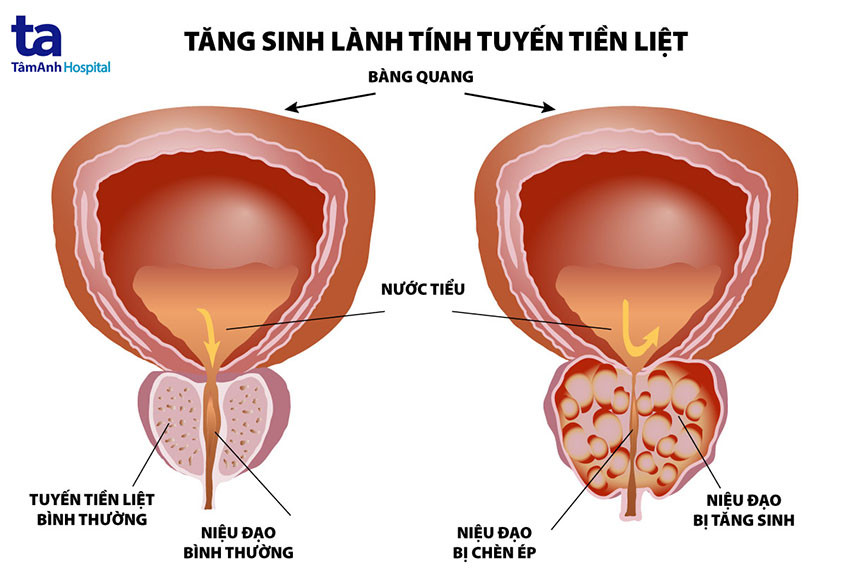 Tuyến tiền liệt phì đại chèn ép niệu đạo