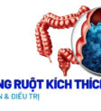 hội chứng ruột kích thích là gì