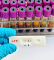 Xét nghiệm AFP được sử dụng để phát hiện dị tật bẩm sinh ở thai nhi, giúp các bậc cha mẹ có sự chuẩn bị tốt nhất cho tương lai của con mình.