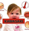 Bé trai với biểu hiện mắt đỏ do bệnh Kawasaki