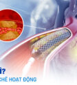 Stent là gì?
