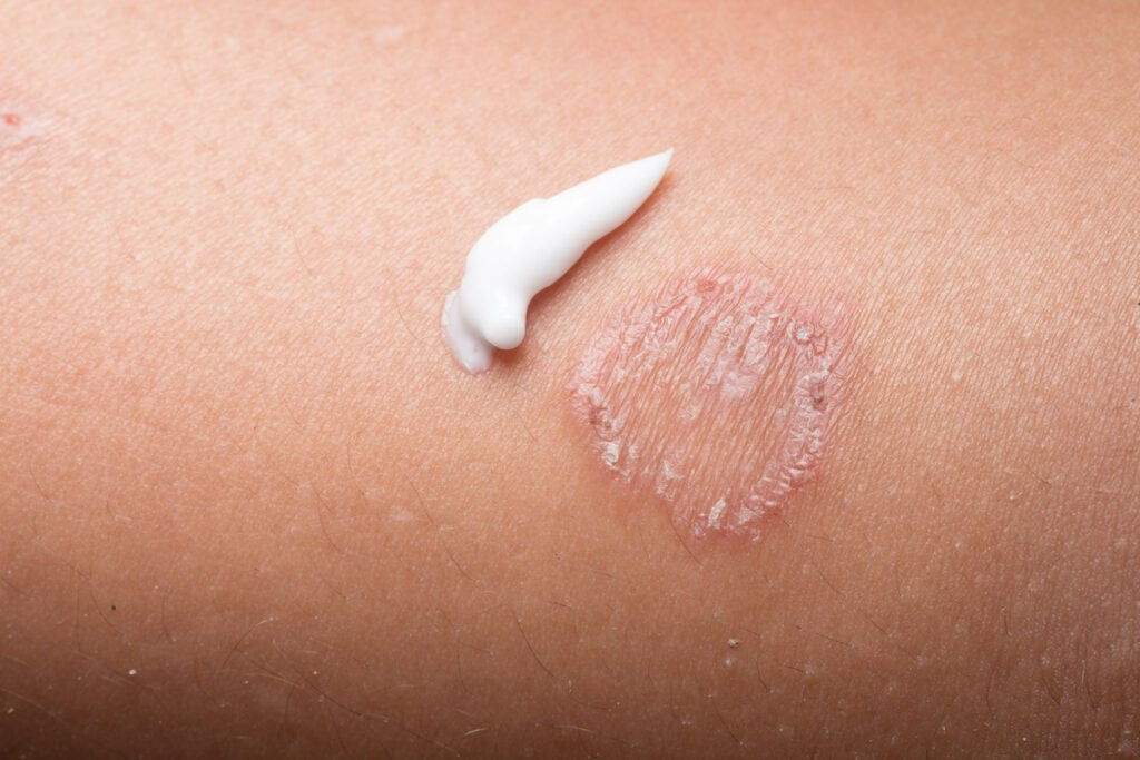 Sử dụng thuốc bôi trị lác đồng tiền