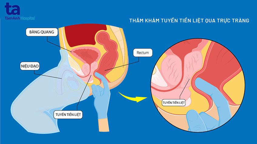 ThÄm khám tuyến tiá»n liệt qua trá»±c trà ng