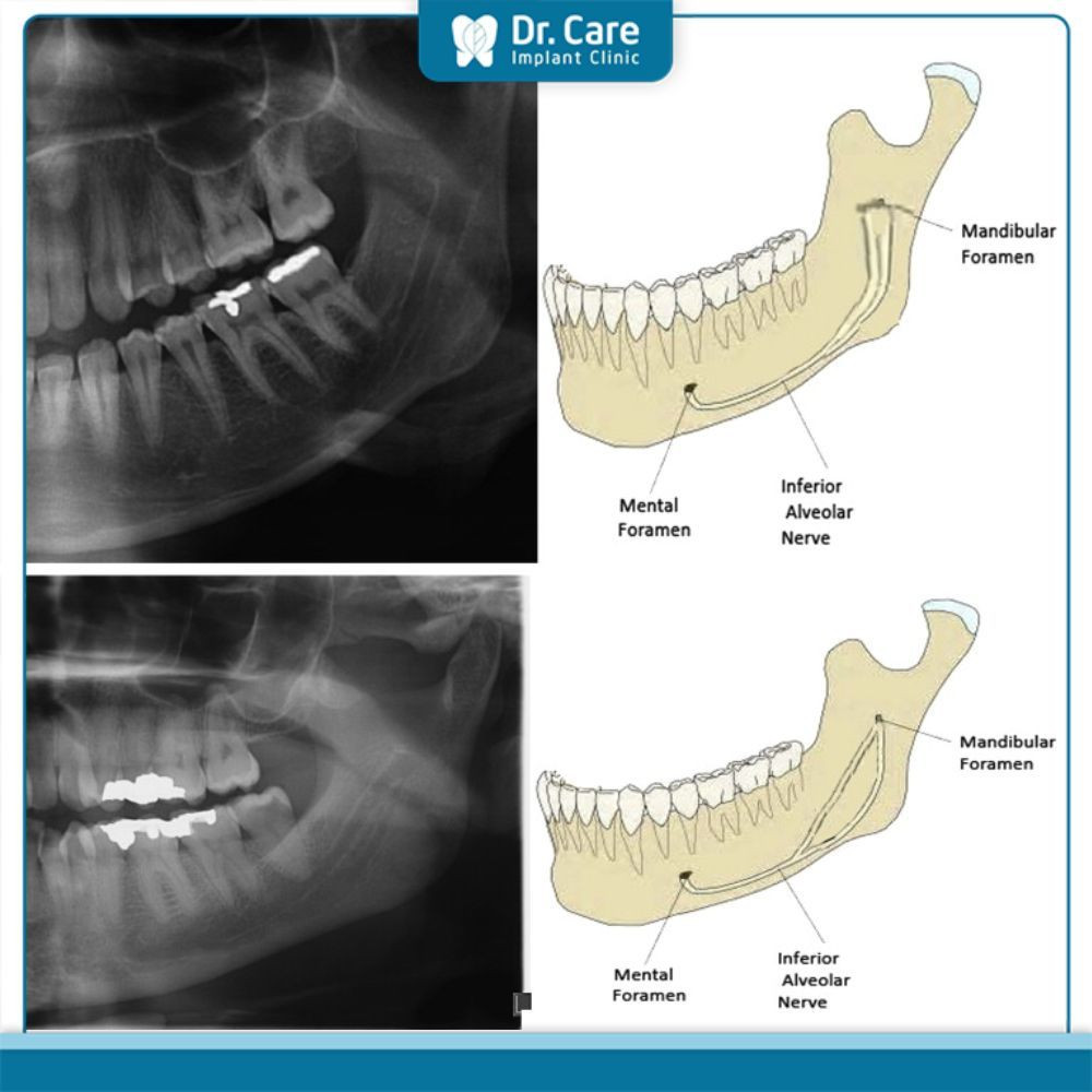Các loại cone phổ biến trong ẩm thực Mỹ